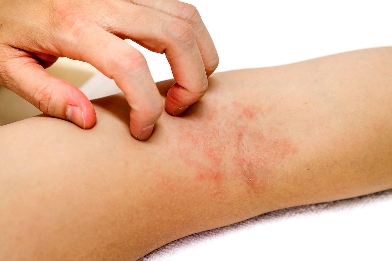 هنگام گزیدگی چه موقع به پزشک مراجعه کنیم؟